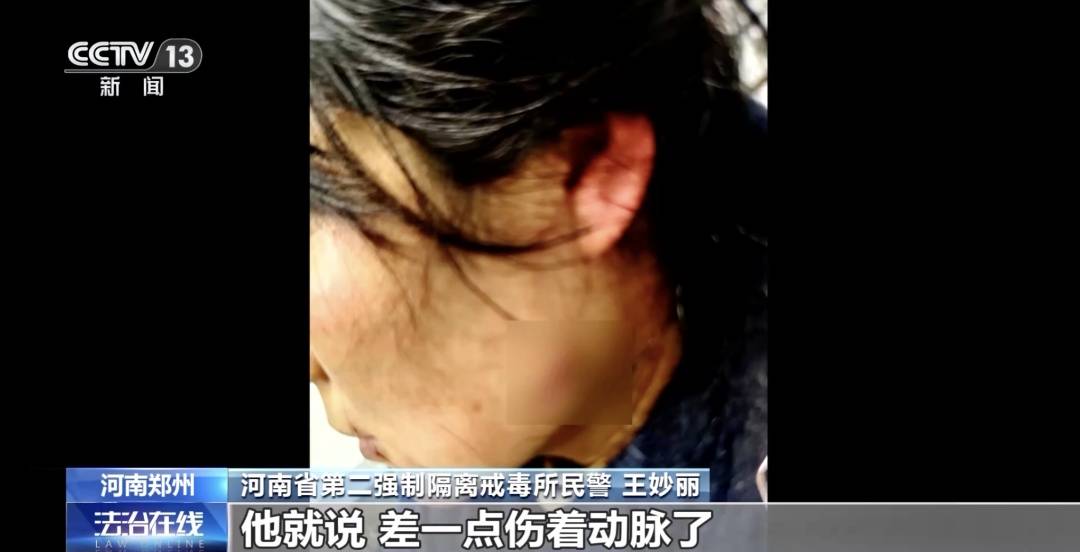 皇冠信用盘注册_女警徒手夺刀皇冠信用盘注册，脸上缝30多针：后怕但不后悔